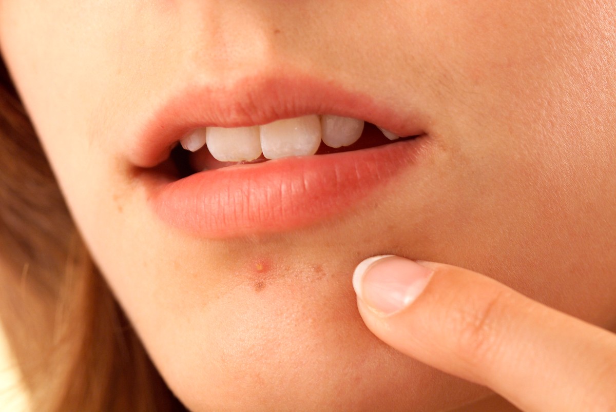 Traiter son acné soi-même, c'est possible ! – PILLS, LE MAG